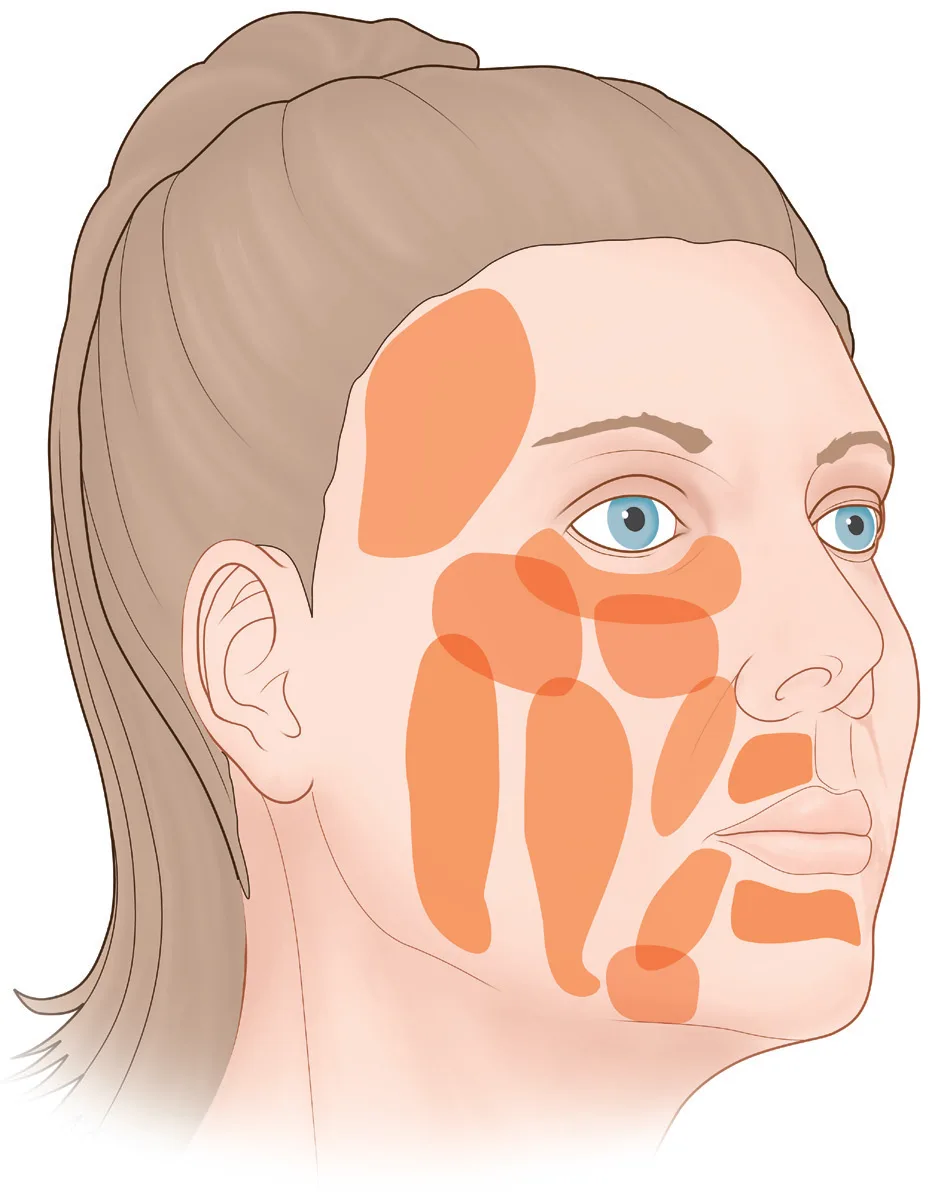 Fig 4. Mosaic of fat compartments in three-quarter view